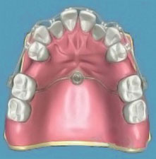 A graphical representation of an orthordontic dental implant